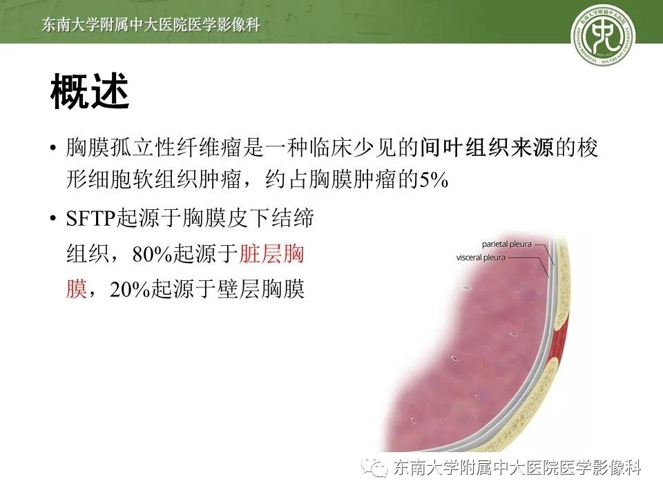 【PPT】胸膜孤立性纤维瘤
