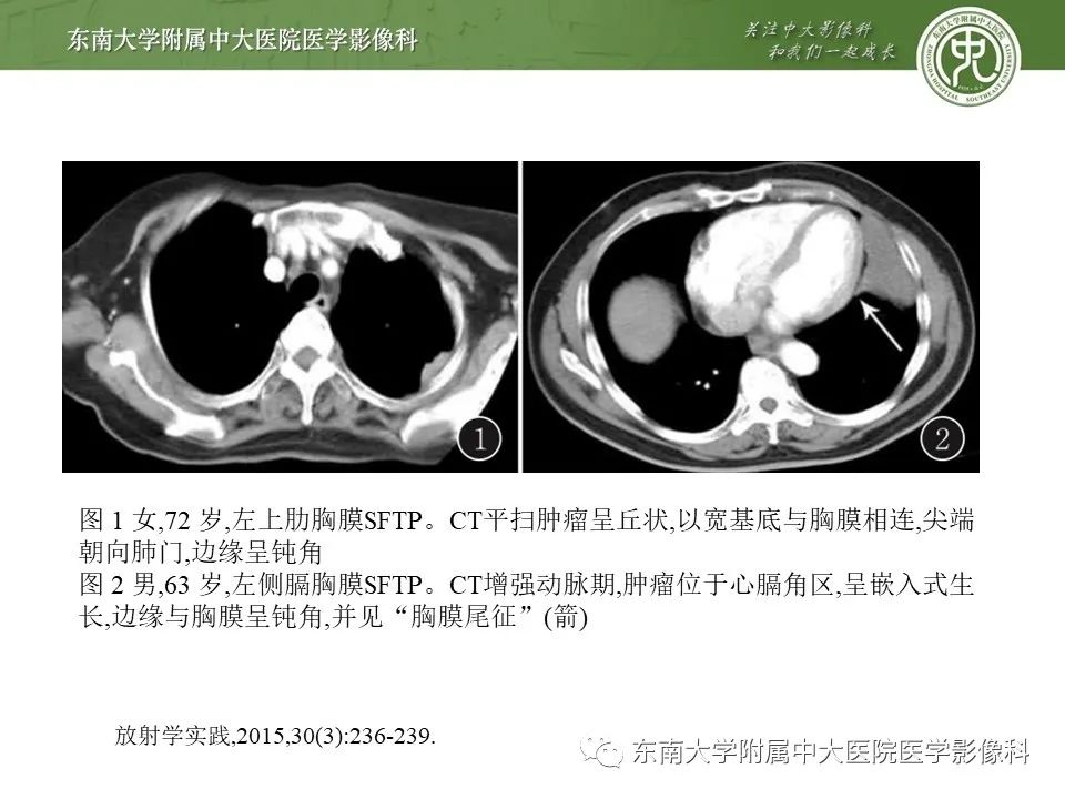 【PPT】胸膜孤立性纤维瘤