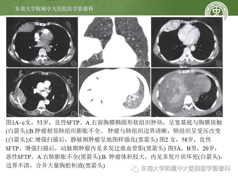 【PPT】胸膜孤立性纤维瘤