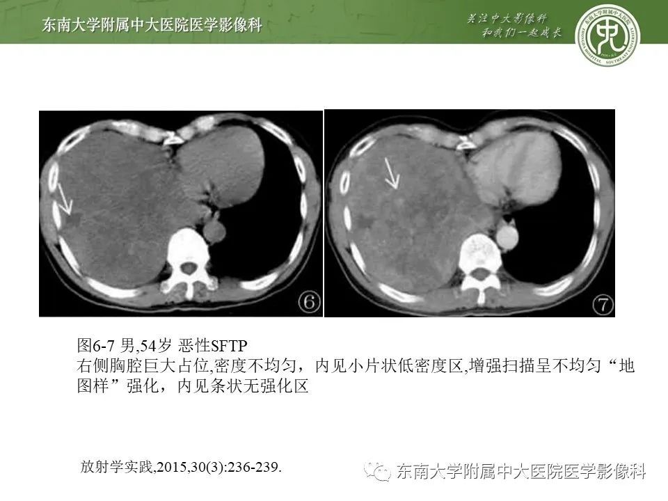 【PPT】胸膜孤立性纤维瘤