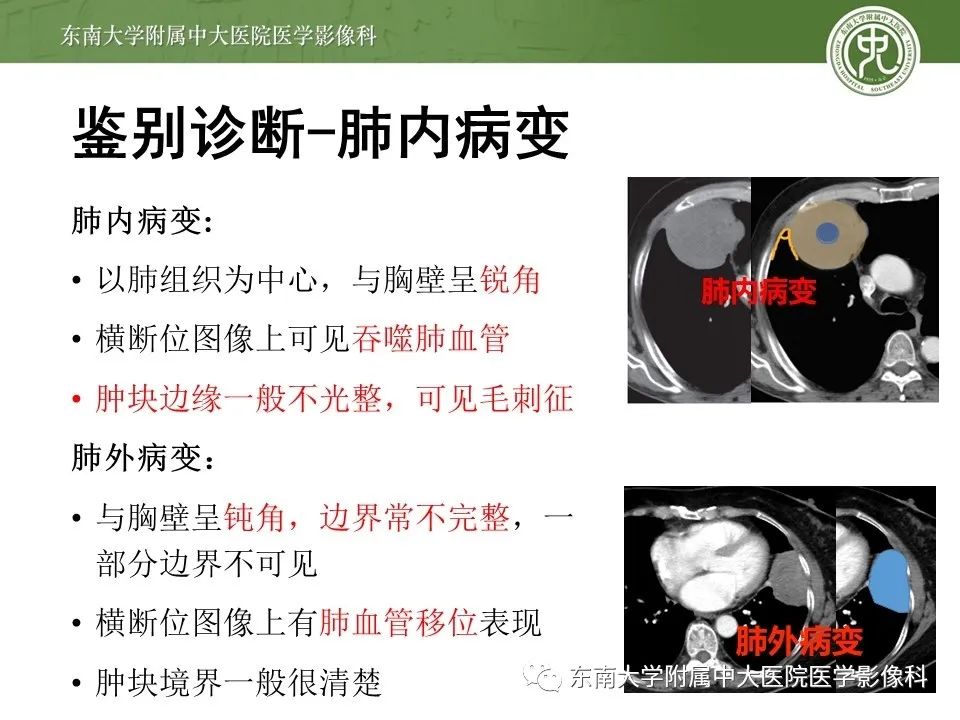 【PPT】胸膜孤立性纤维瘤