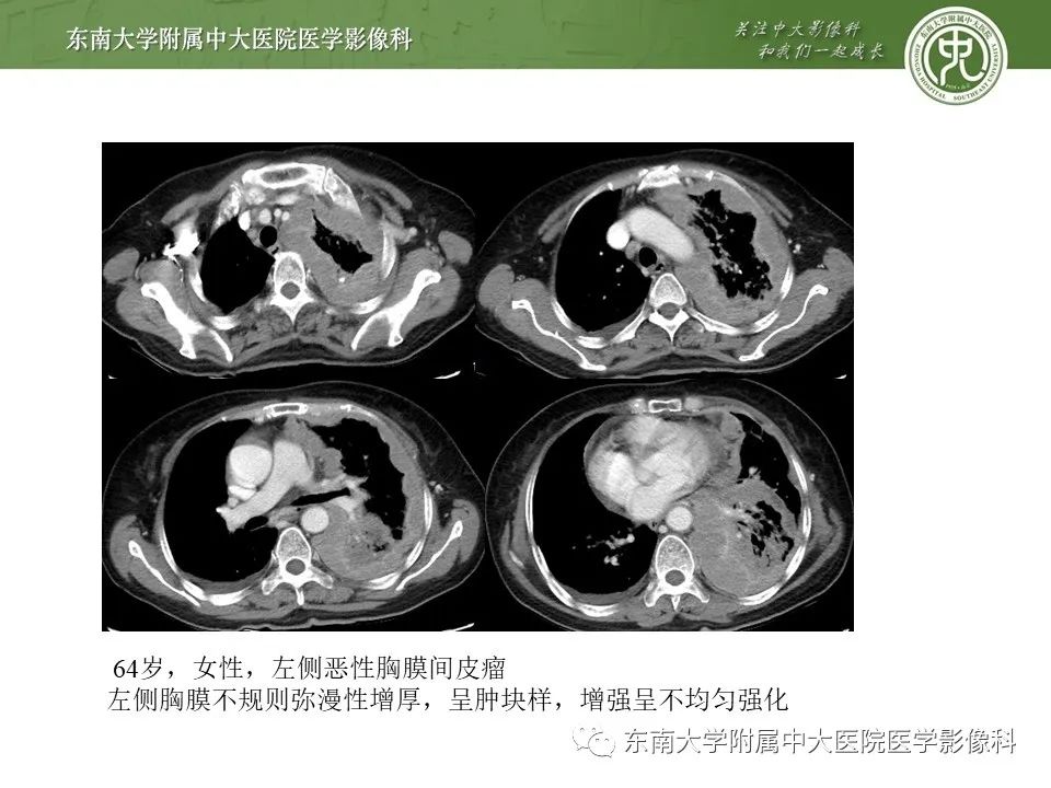 【PPT】胸膜孤立性纤维瘤