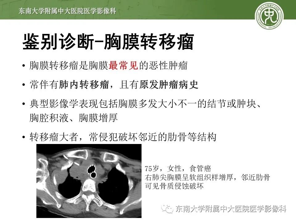 【PPT】胸膜孤立性纤维瘤