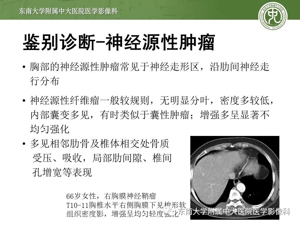 【PPT】胸膜孤立性纤维瘤