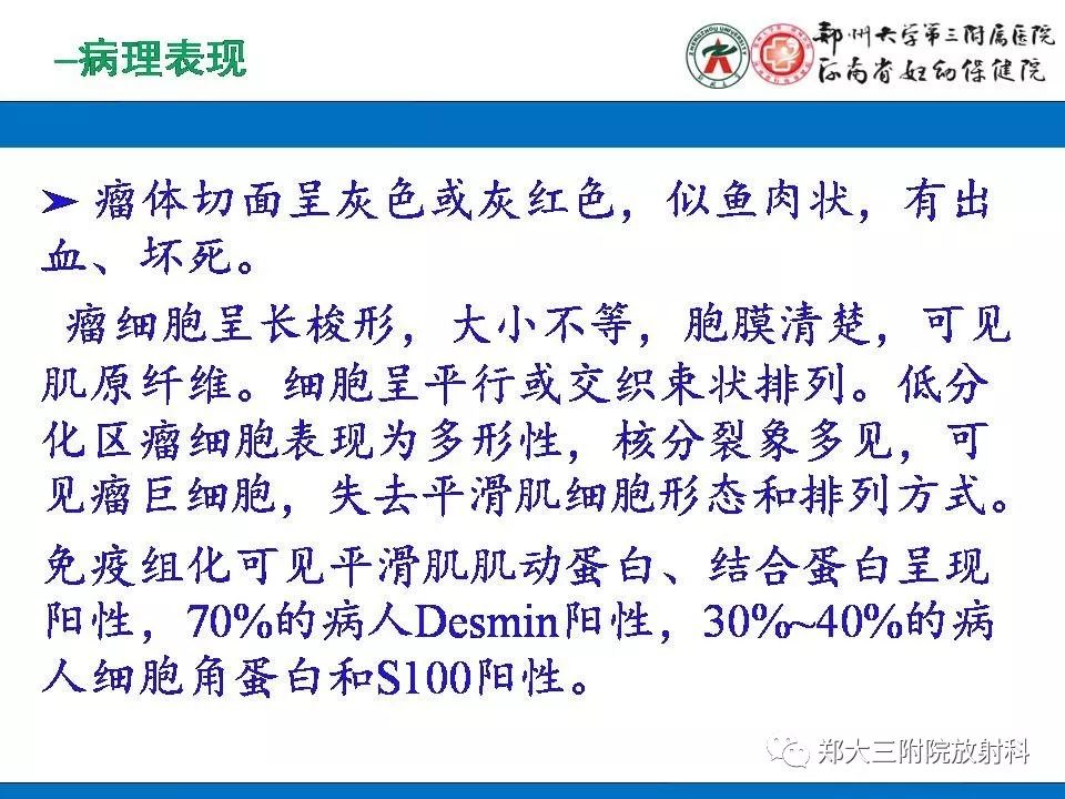 【PPT】腹膜后平滑肌肉瘤的影像表现