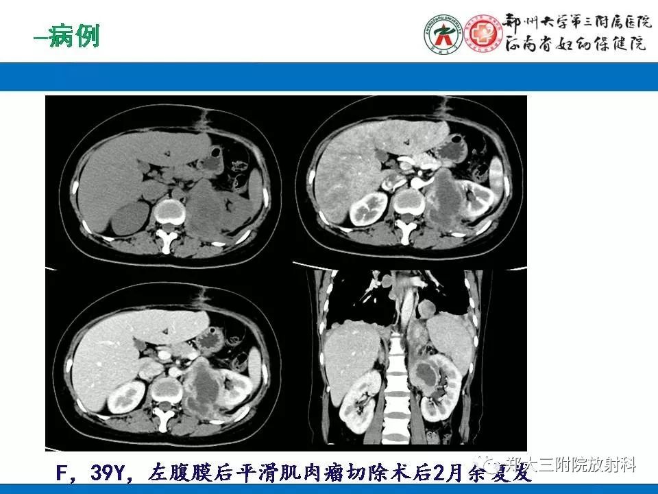 【PPT】腹膜后平滑肌肉瘤的影像表现