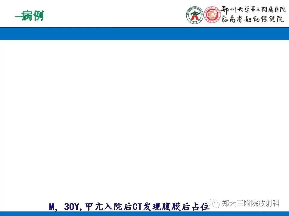 【PPT】腹膜后平滑肌肉瘤的影像表现