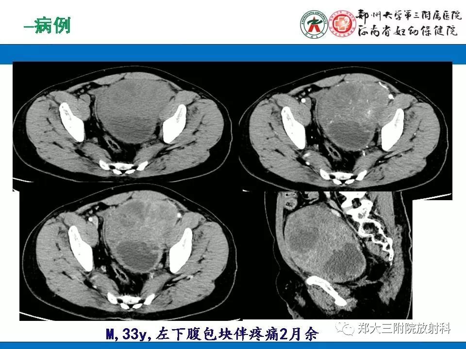 【PPT】腹膜后平滑肌肉瘤的影像表现