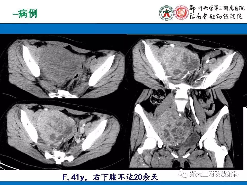 【PPT】腹膜后平滑肌肉瘤的影像表现
