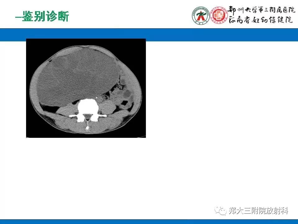 【PPT】腹膜后平滑肌肉瘤的影像表现