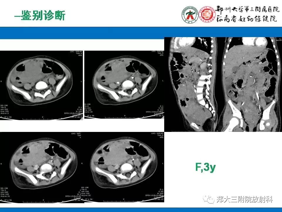 【PPT】腹膜后平滑肌肉瘤的影像表现