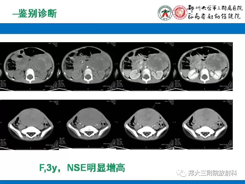 【PPT】腹膜后平滑肌肉瘤的影像表现