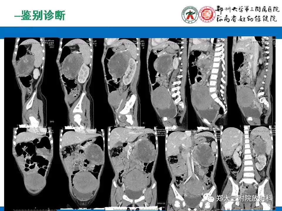 【PPT】腹膜后平滑肌肉瘤的影像表现
