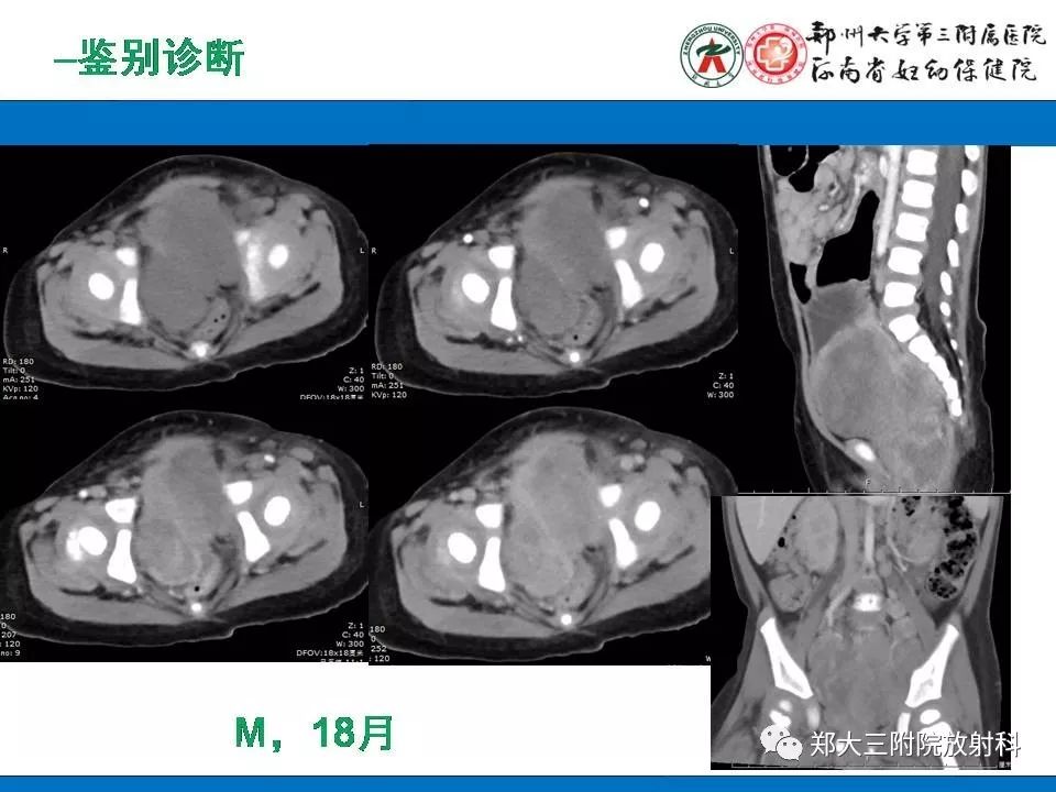 【PPT】腹膜后平滑肌肉瘤的影像表现