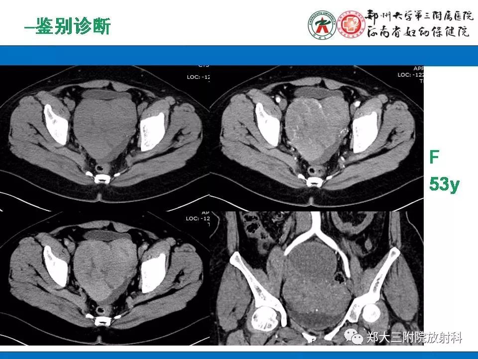 【PPT】腹膜后平滑肌肉瘤的影像表现