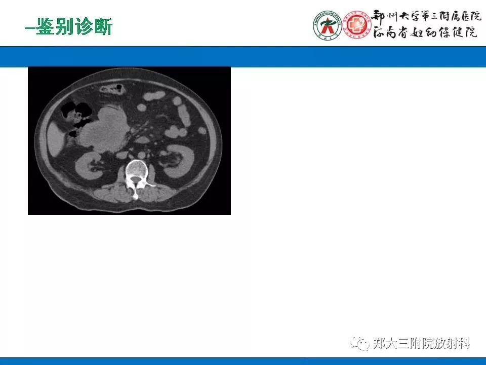 【PPT】腹膜后平滑肌肉瘤的影像表现