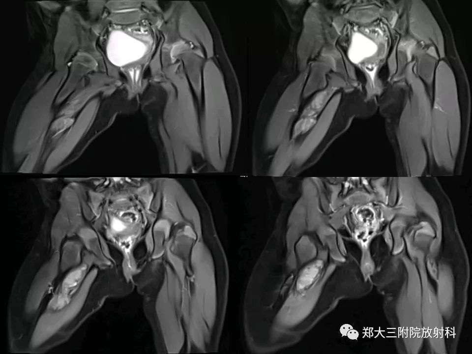 【PPT】韧带样纤维瘤