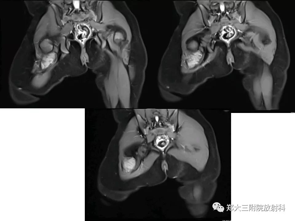 【PPT】韧带样纤维瘤