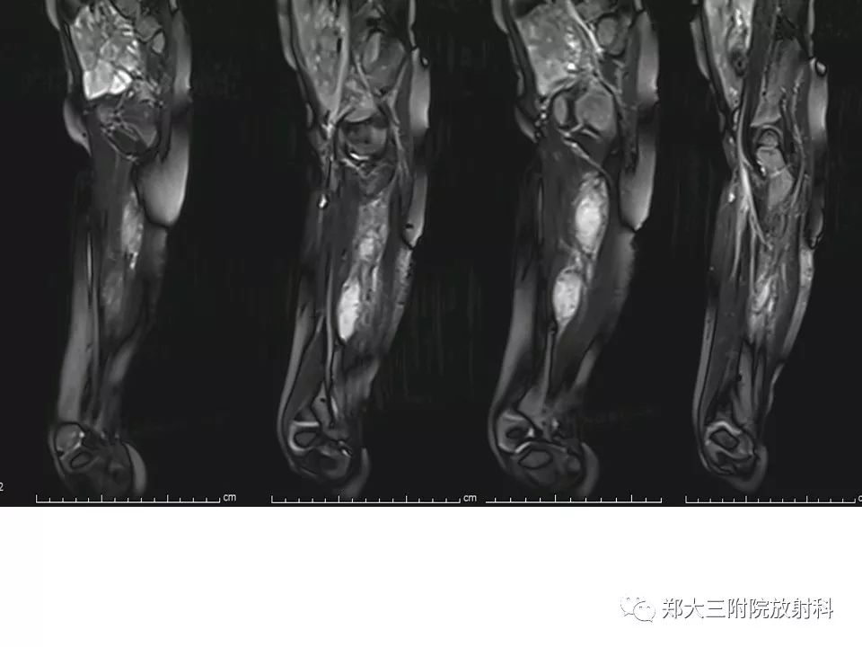 【PPT】韧带样纤维瘤