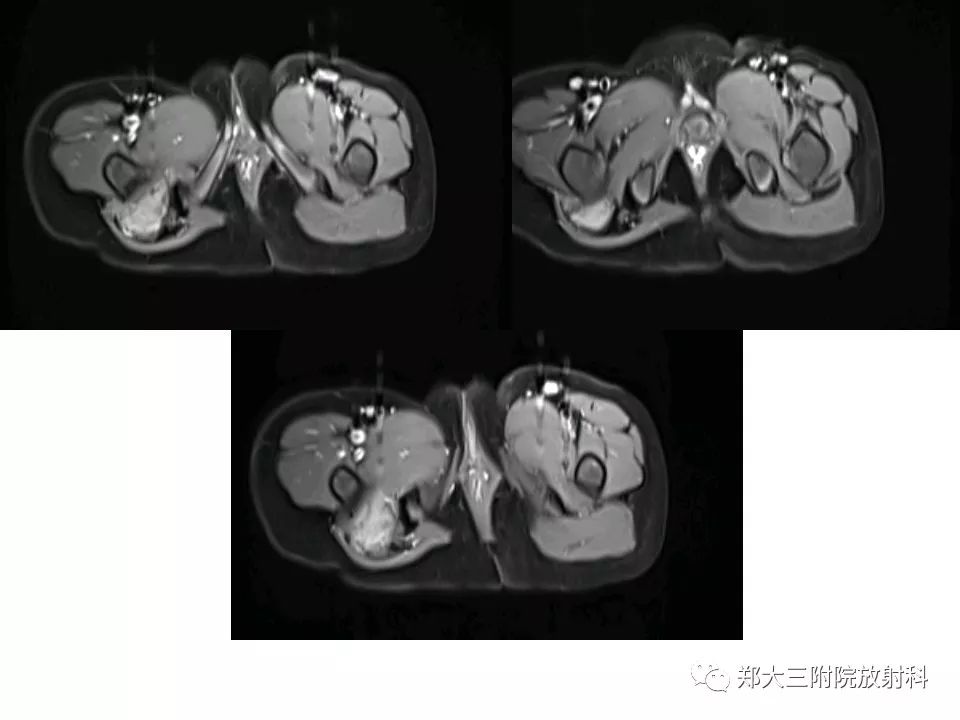 【PPT】韧带样纤维瘤