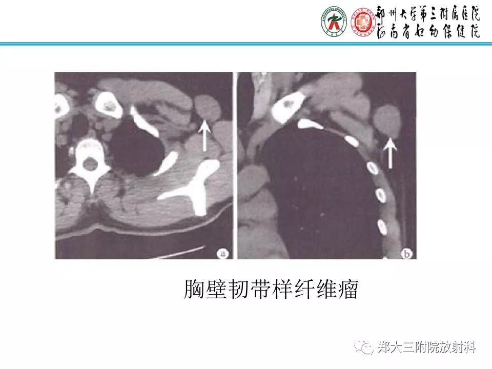 【PPT】韧带样纤维瘤