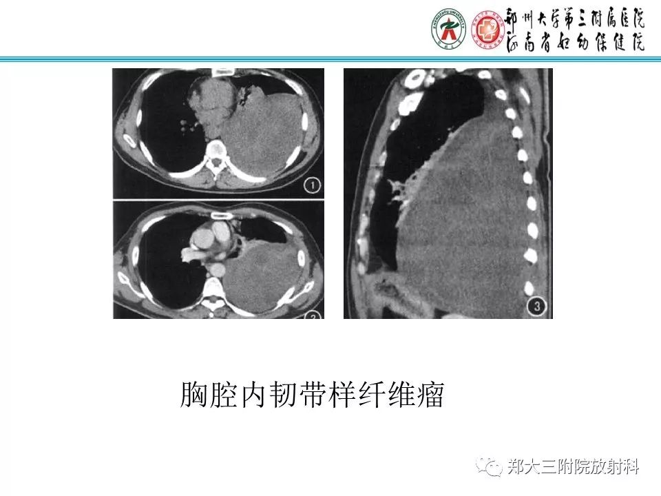 【PPT】韧带样纤维瘤