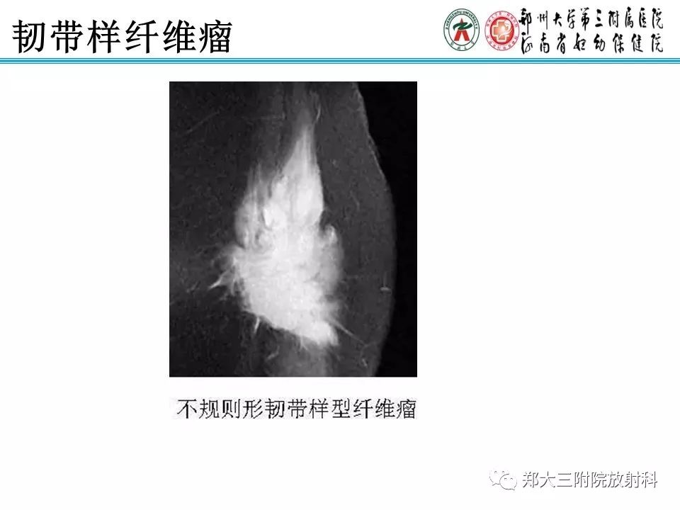 【PPT】韧带样纤维瘤