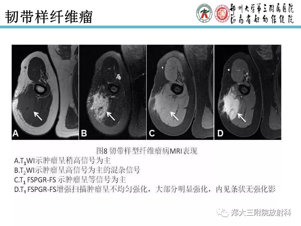 【PPT】韧带样纤维瘤