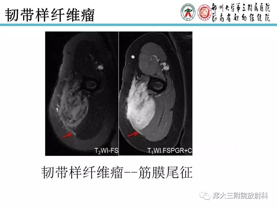 【PPT】韧带样纤维瘤
