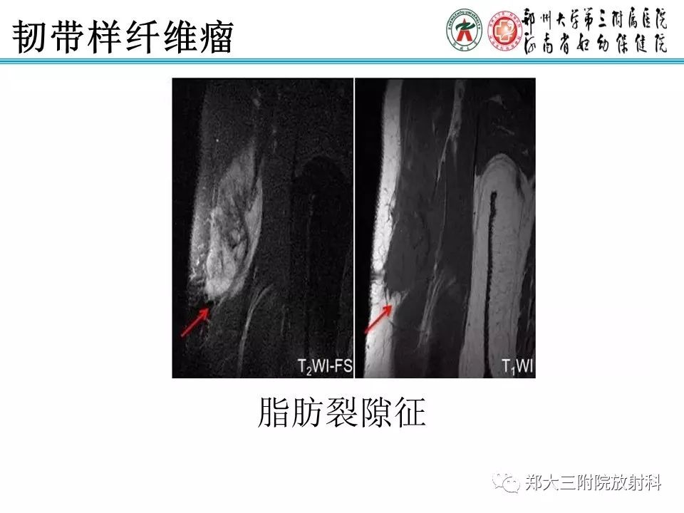 【PPT】韧带样纤维瘤