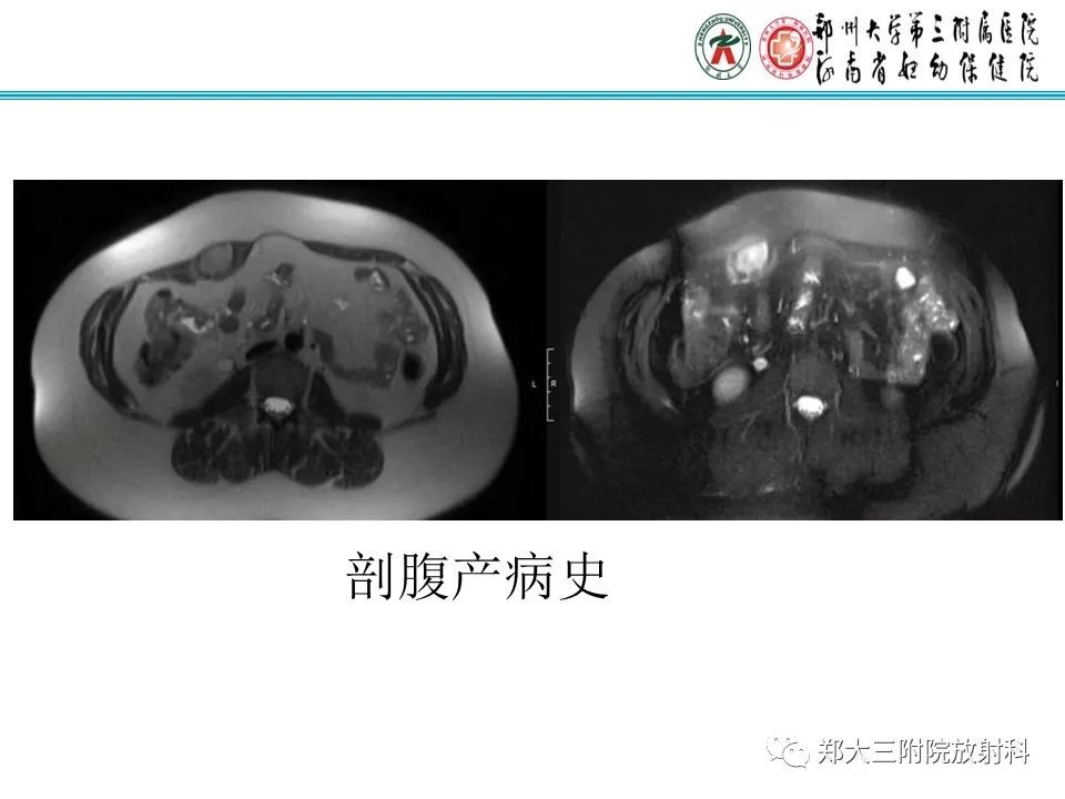 【PPT】韧带样纤维瘤
