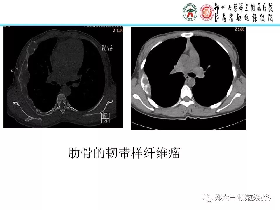 【PPT】韧带样纤维瘤
