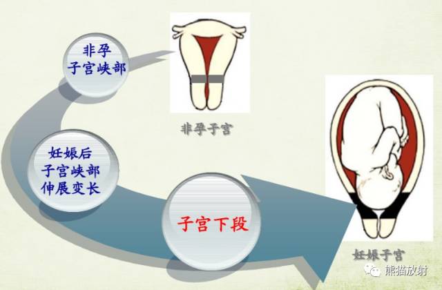 前置胎盘和胎盘植入