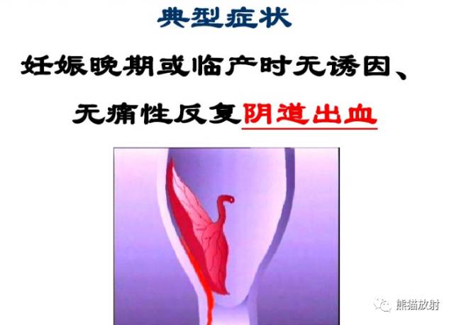 前置胎盘和胎盘植入