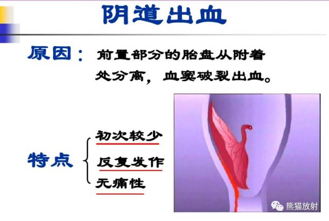前置胎盘和胎盘植入