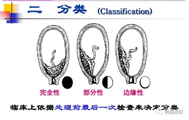 前置胎盘和胎盘植入