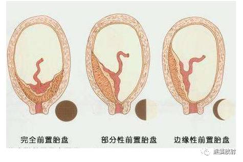 前置胎盘和胎盘植入