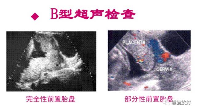 前置胎盘和胎盘植入