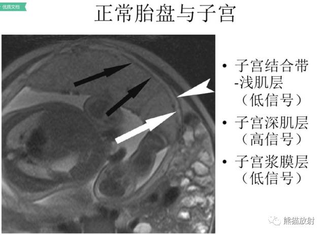 前置胎盘和胎盘植入
