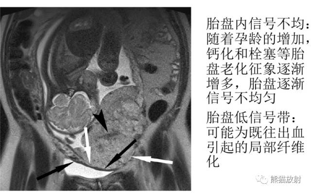 前置胎盘和胎盘植入