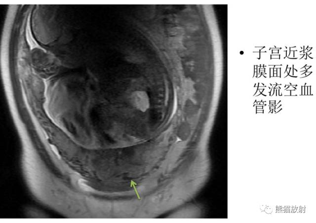 前置胎盘和胎盘植入
