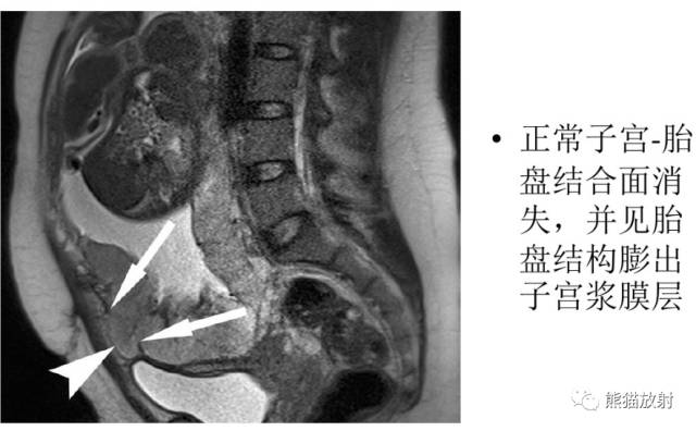 前置胎盘和胎盘植入