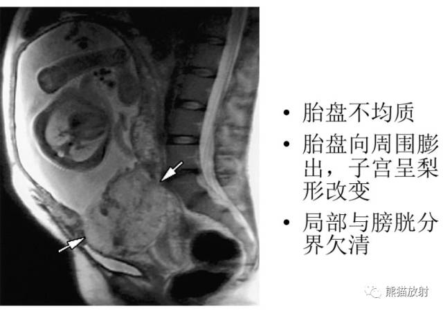 前置胎盘和胎盘植入