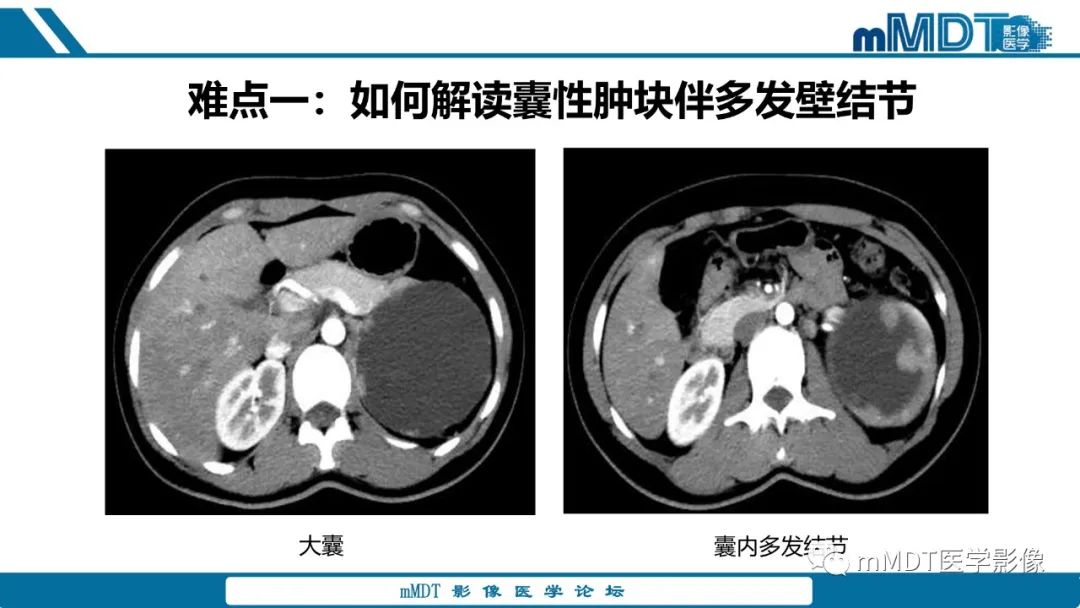 【PPT】肾髓质癌1例CT影像