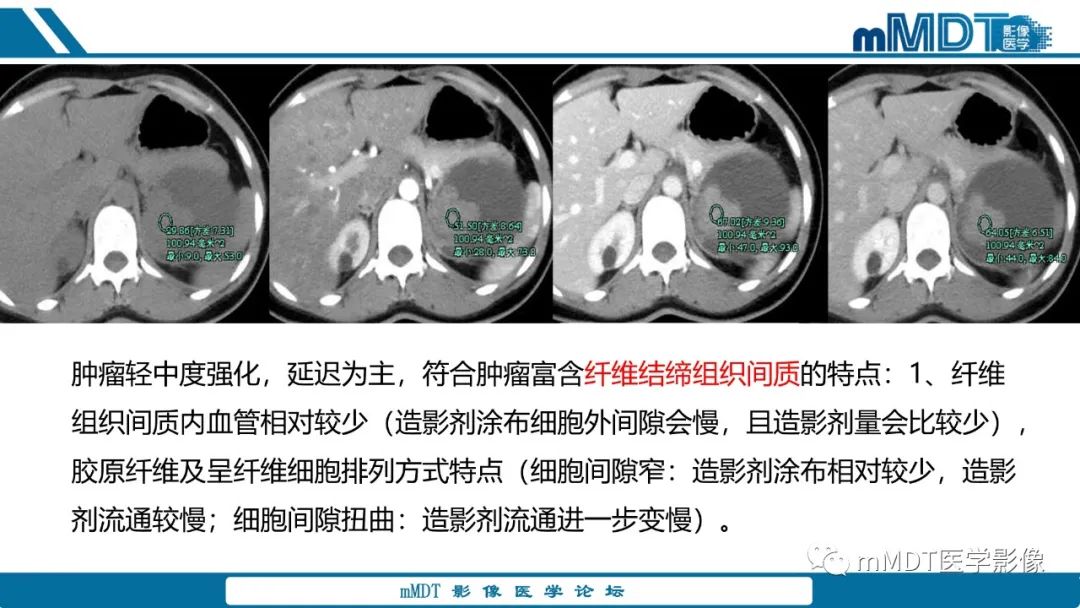 【PPT】肾髓质癌1例CT影像