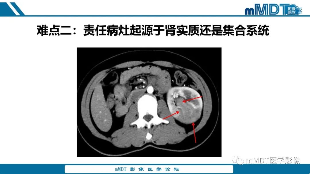 【PPT】肾髓质癌1例CT影像