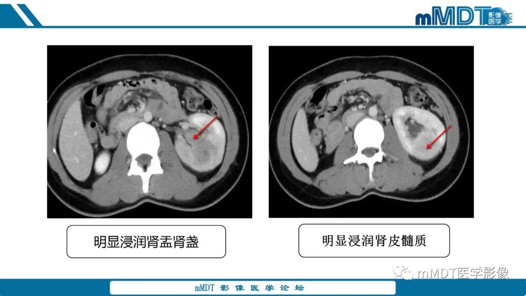 【PPT】肾髓质癌1例CT影像
