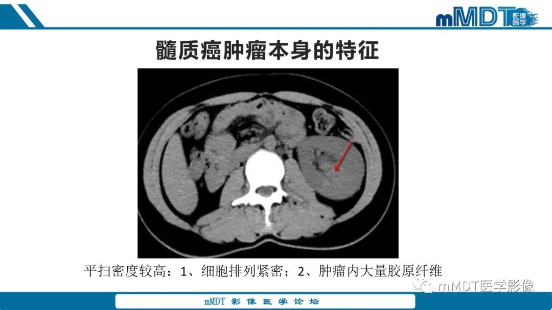 【PPT】肾髓质癌1例CT影像