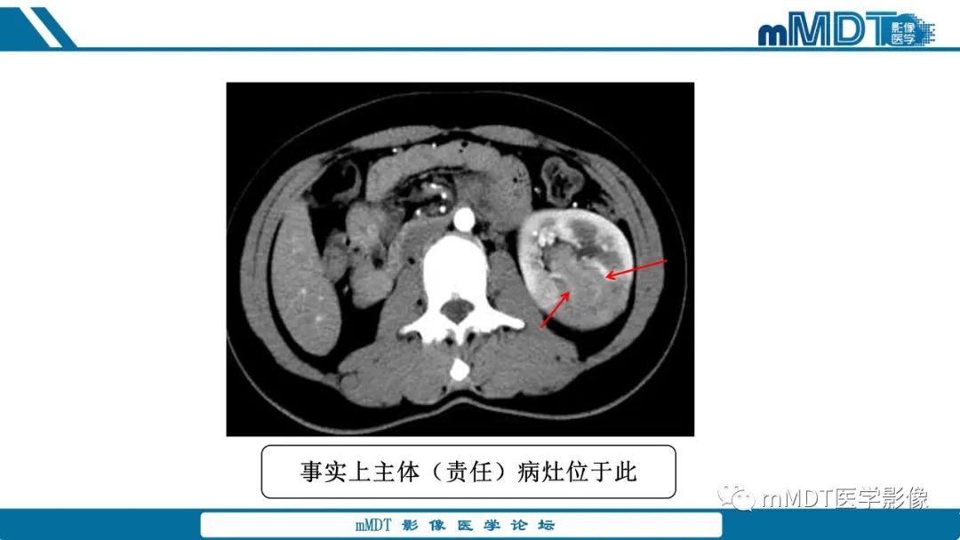 【PPT】肾髓质癌1例CT影像