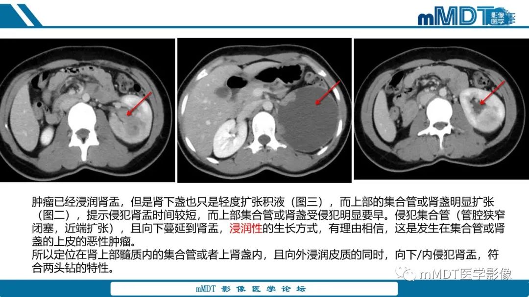 【PPT】肾髓质癌1例CT影像